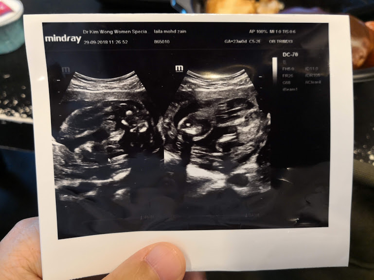 sex of baby gender reveal 6 months